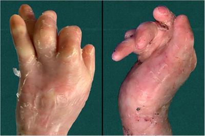 Simple and affordable soft brace application in dystrophic epidermolysis bullosa patients